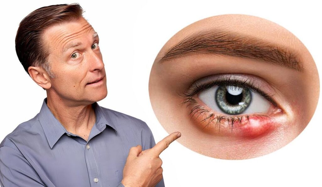 Causes of a Stye