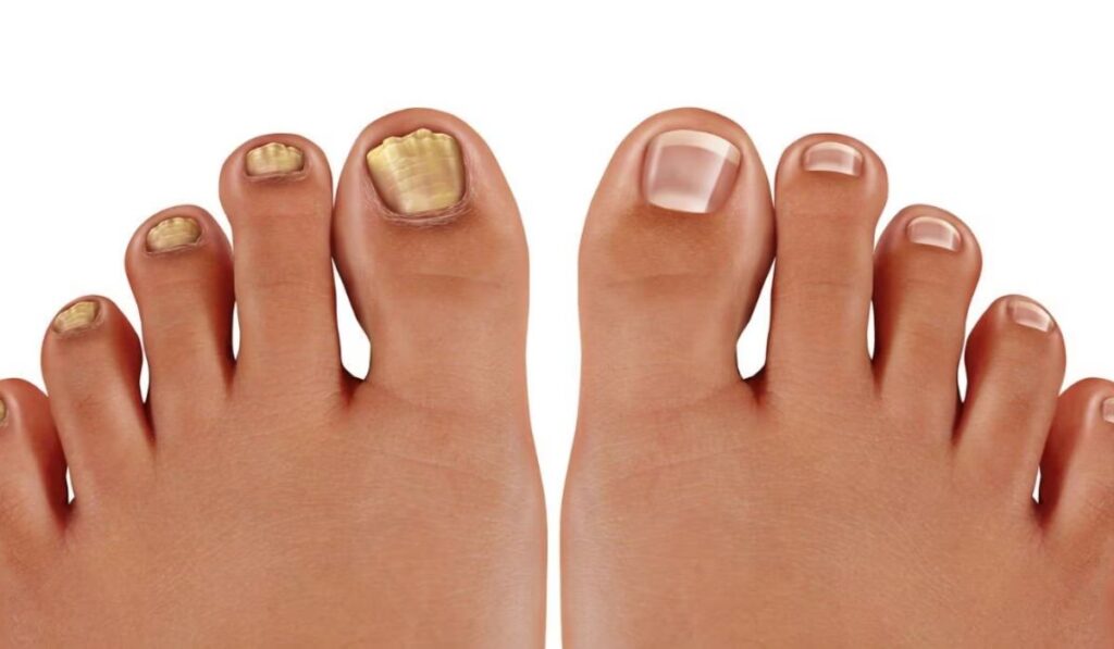 Decoding Toenail