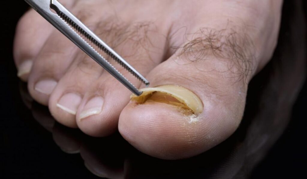 Toenail Loss or Injury